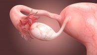 infertility ovary